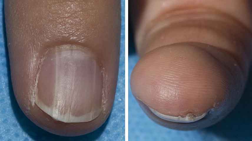 Benign nail abnormality may greatly increase cancer risk, scientists warn 