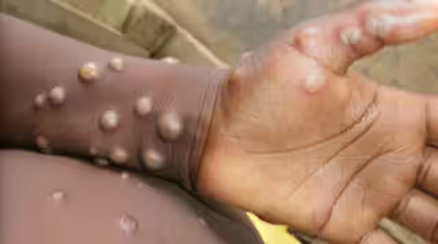 mpox in Pakistan