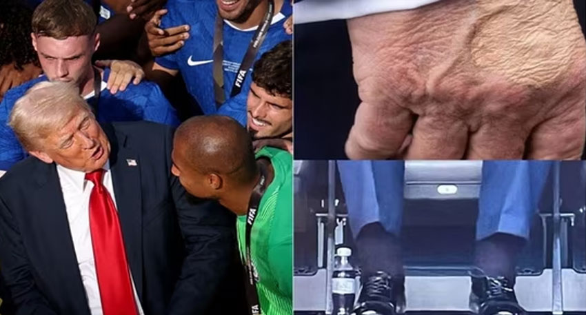White House addresses President Trump’s bruised hands and swollen legs file photo