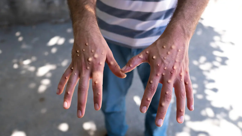 Monkeypox virus. File photo