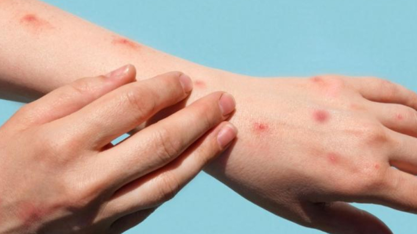 Nine dead as monkeypox surge hits Sindh. File photo