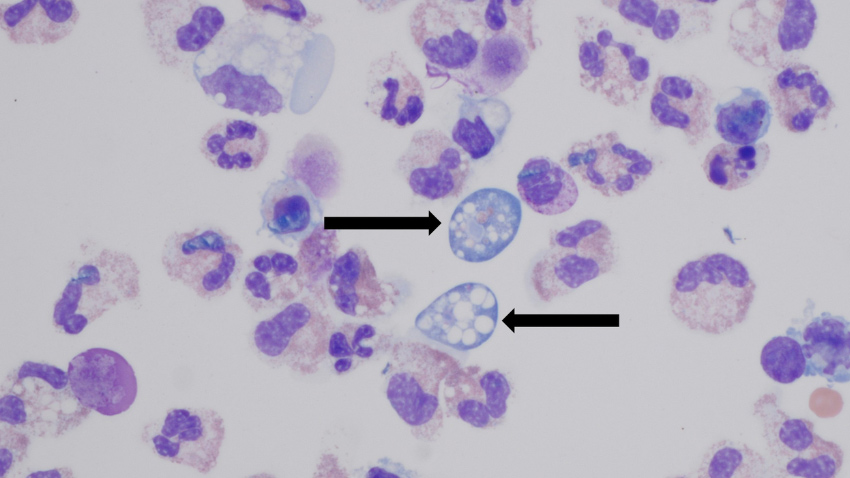 Karachi reports its first Naegleria death of 2026. File photo