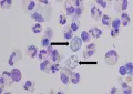 First brain-eating amoeba death reported in Karachi