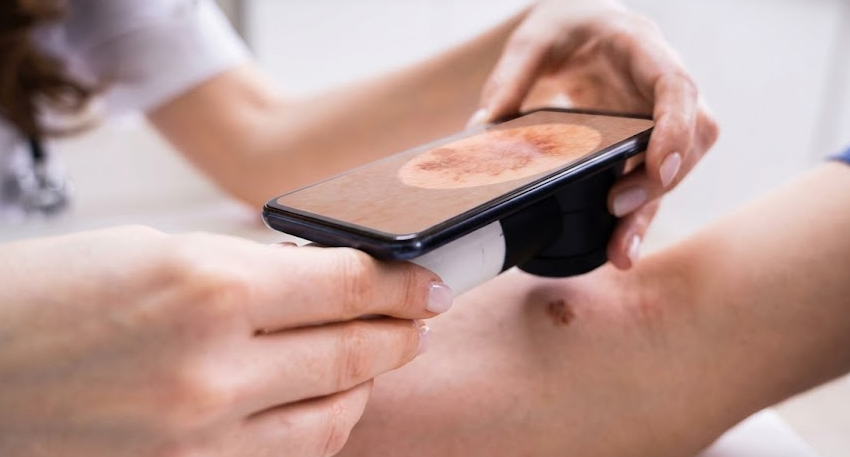 Doctor using a smartphone with a specialized magnifying lens to scan a mole on a patient's arm.