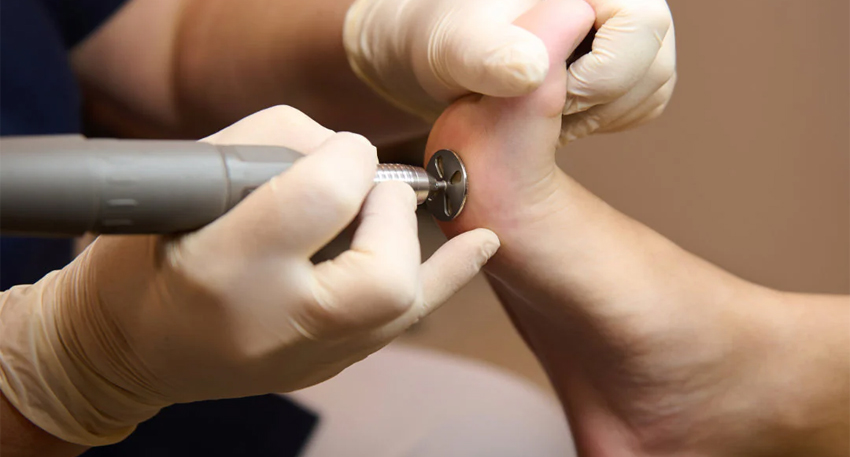 medical pedicure is used to treat severe calluses and cracked heels.